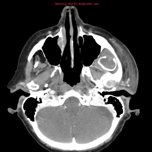 File:Ameloblastoma (Radiopaedia 27437-27631 A 13).jpg
