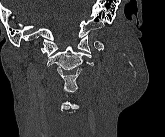 Ameloblastoma (Radiopaedia 51921-57766 Coronal bone window 228).jpg