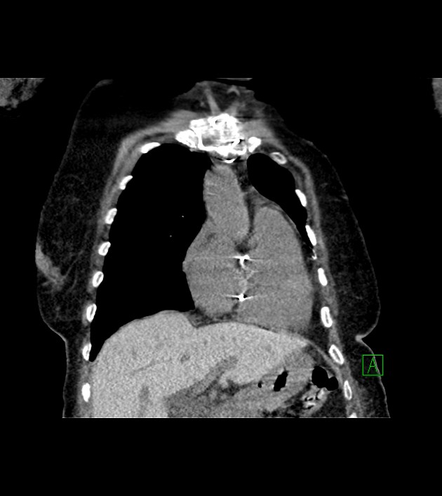 Amiodarone deposition in the liver (Radiopaedia 77587-89780 Coronal non-contrast 25).jpg