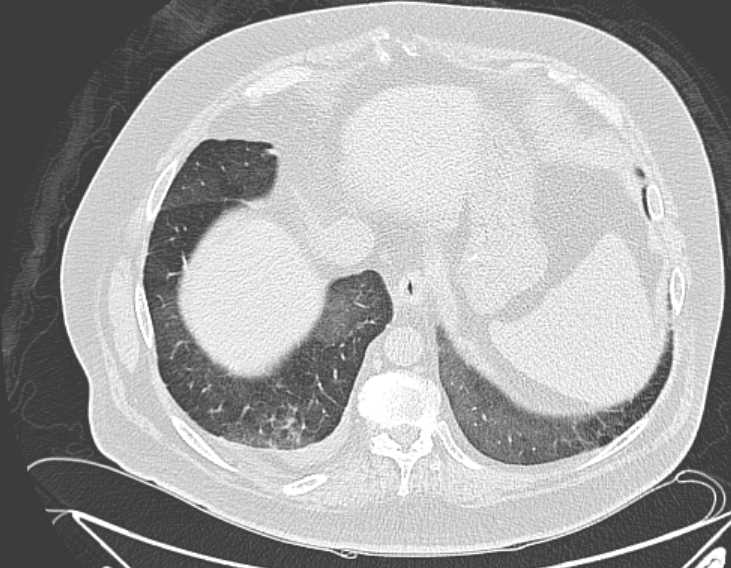 File:Amiodarone lung (Radiopaedia 62514-70769 Axial lung window 72).jpg