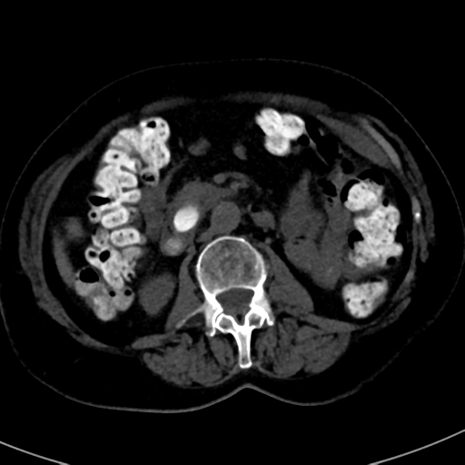 File:Ampullary adenocarcinoma (Radiopaedia 34013-35241 AXIAL THICK 46).png