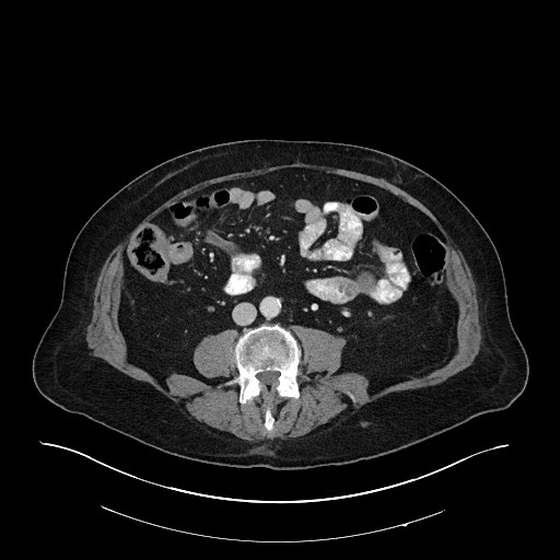 Ampullary adenocarcinoma (Radiopaedia 59373-66734 C 93).jpg