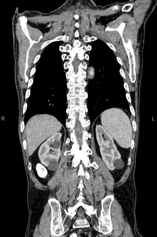 Ampullary adenocarcinoma (Radiopaedia 86093-102033 D 49).jpg