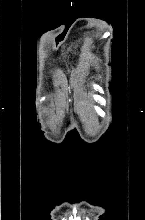 Ampullary adenocarcinoma (Radiopaedia 86093-102033 D 63).jpg