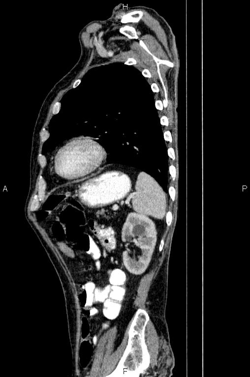 Ampullary adenocarcinoma (Radiopaedia 86093-102033 E 71).jpg