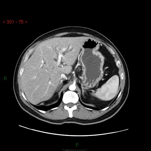 Ampullary carcinoma (Radiopaedia 56396-63056 B 21).jpg