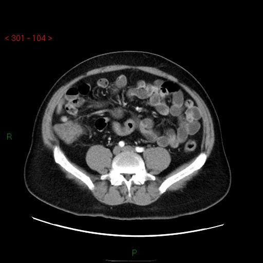 File:Ampullary carcinoma (Radiopaedia 56396-63056 B 50).jpg