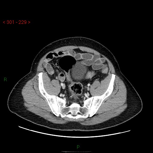 Ampullary carcinoma (Radiopaedia 56396-63056 C 80).jpg