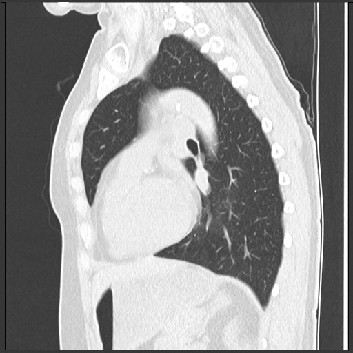 Amyloidosis - bronchial and diffuse nodular pulmonary involvement (Radiopaedia 60156-67744 F 35).jpg