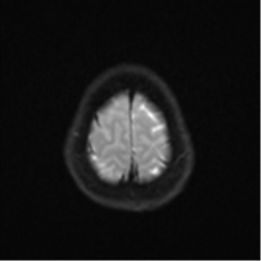Anaplastic astroblastoma (Radiopaedia 55666-62194 Axial DWI 26).png