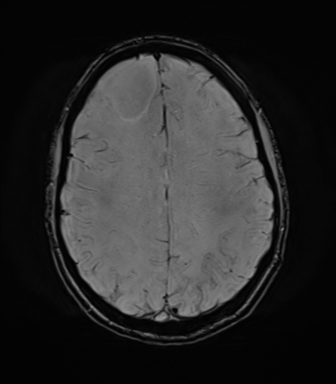 File:Anaplastic astrocytoma IDH mutant (Radiopaedia 50046-55341 Axial SWI 61).png