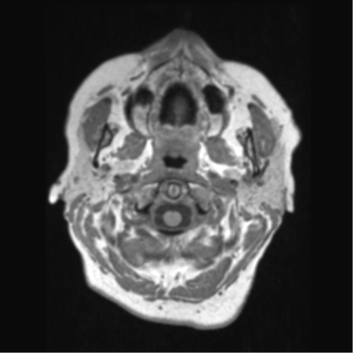 File:Anaplastic astrocytoma IDH wild-type (pseudoprogression) (Radiopaedia 42209-45276 Axial T1 11).png