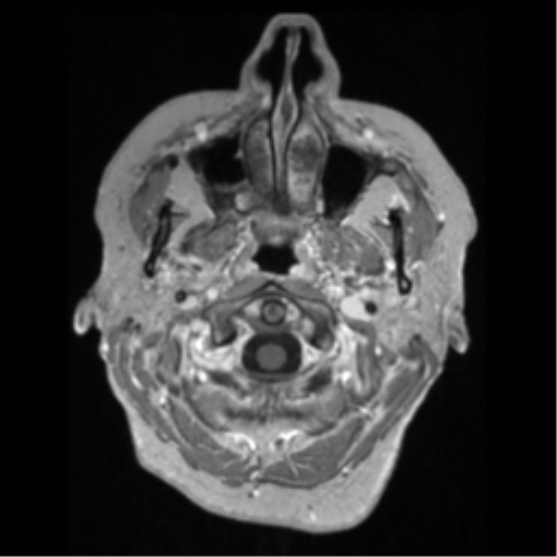 File:Anaplastic astrocytoma IDH wild-type (pseudoprogression) (Radiopaedia 42209-45276 Axial T1 C+ 12).png