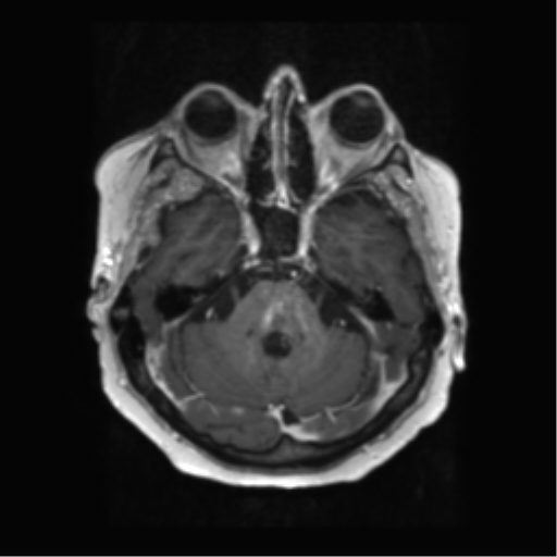 Anaplastic astrocytoma IDH wild-type (pseudoprogression) (Radiopaedia 42209-45279 Axial T1 C+ 44).png