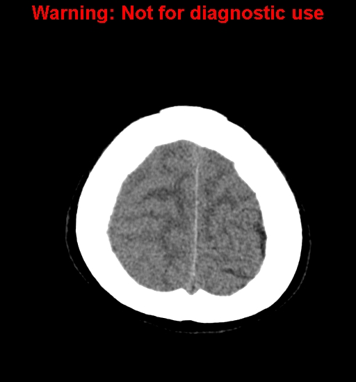 File:Anaplastic ganglioglioma (Radiopaedia 44921-48815 Axial non-contrast 25).jpg