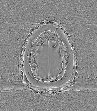 Anaplastic oligodendroglioma (Radiopaedia 83500-98599 Axial SWI - phase 81).png
