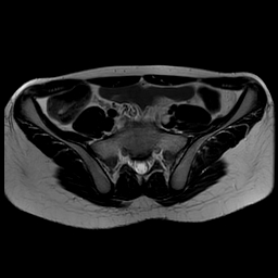 File:Androgen insensitivity syndrome (Radiopaedia 38585-40727 Axial T2 2).jpg