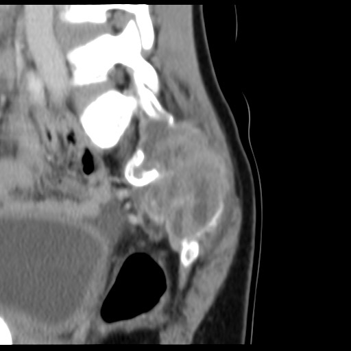 File:Aneurysmal bone cyst - sacrum (Radiopaedia 65190-74195 A 22).jpg