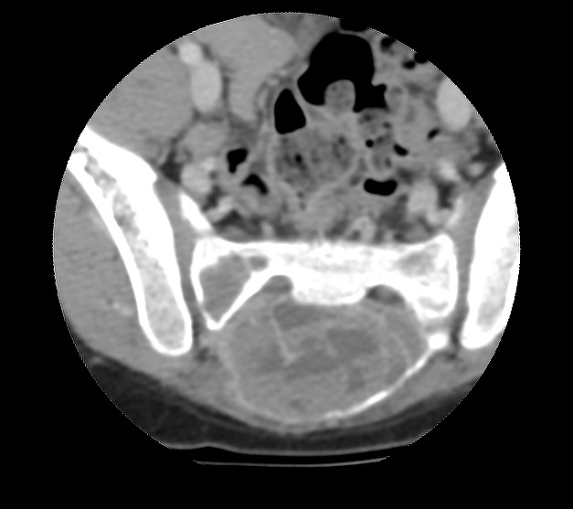 Aneurysmal bone cyst - sacrum (Radiopaedia 65190-74195 Axial non-contrast 26).jpg