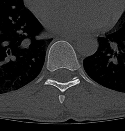 File:Aneurysmal bone cyst T11 (Radiopaedia 29294-29721 Axial bone window 16).jpg