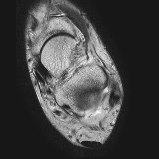 File:Aneurysmal bone cyst of the calcaneus (Radiopaedia 60669-68420 Axial T2 17).jpg