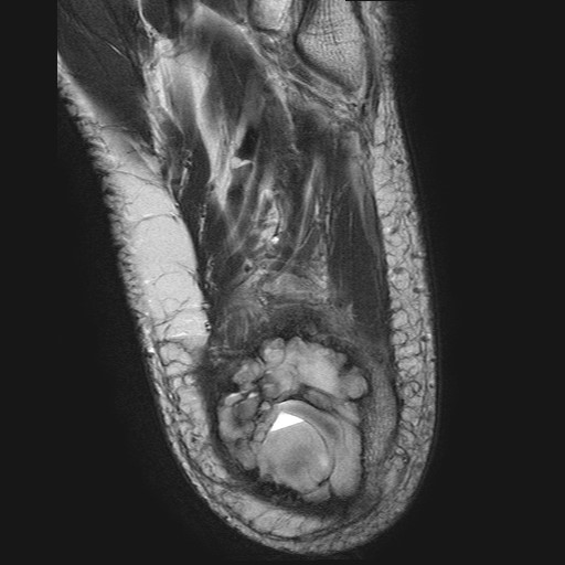 File:Aneurysmal bone cyst of the calcaneus (Radiopaedia 60669-68420 Axial T2 4).jpg