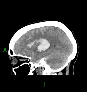 File:Aneurysmal subarachnoid hemorrhage with intra-axial extension (Radiopaedia 84371-99699 B 17).jpg
