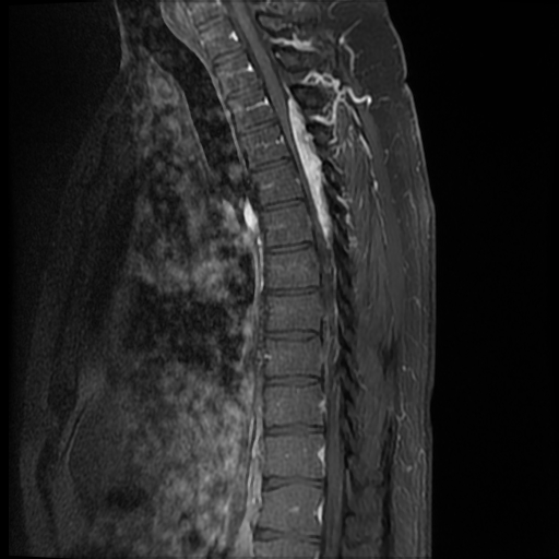 File:Angiolipoma - thoracic spine (Radiopaedia 28242-28479 E 7).jpg
