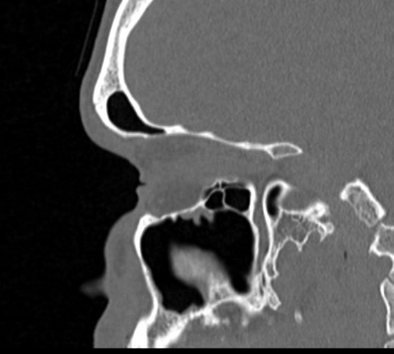 Angular epidermoid cyst (Radiopaedia 46908-51439 Sagittal bone window 27).png