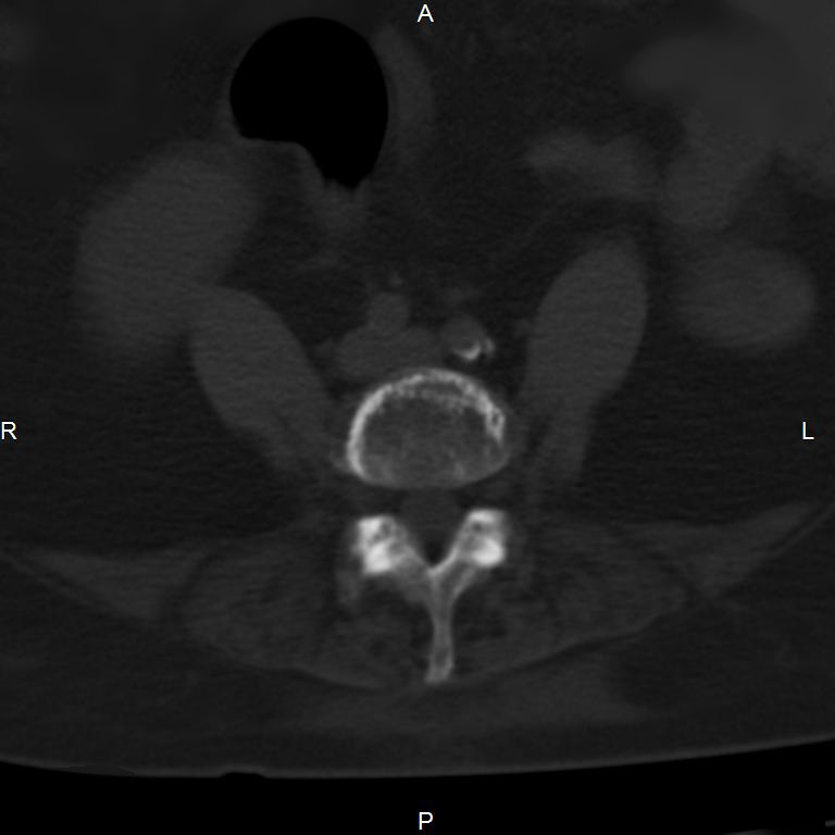 Ankylosing spondylitis (Radiopaedia 8748-9556 Axial bone window 41).jpg