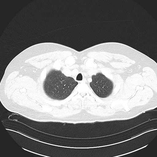 File:Anomalous origin of the left coronary artery with malignant course (Radiopaedia 77842-90126 Axial lung window 7).jpeg