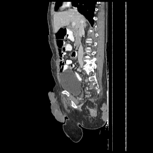 Anorectal carcinoma (Radiopaedia 44413-48064 C 42).jpg