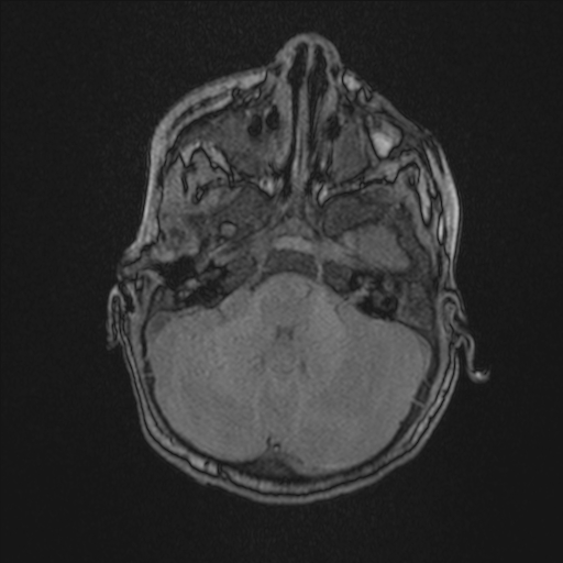 Anoxic brain injury (Radiopaedia 79165-92139 Axial MRA 51).jpg