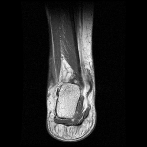 File:Anterior calcaneal process fracture (Radiopaedia 71377-81705 Coronal T1 13).jpg