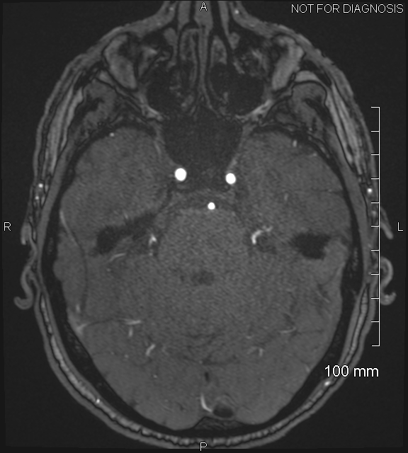 Anterior cerebral artery aneurysm (Radiopaedia 80683-94127 Axial MRA 70).jpg