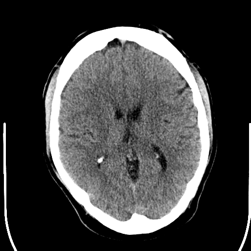 File:Anterior cerebral artery territory infarct (Radiopaedia 39327-41581 Axial non-contrast 16).png