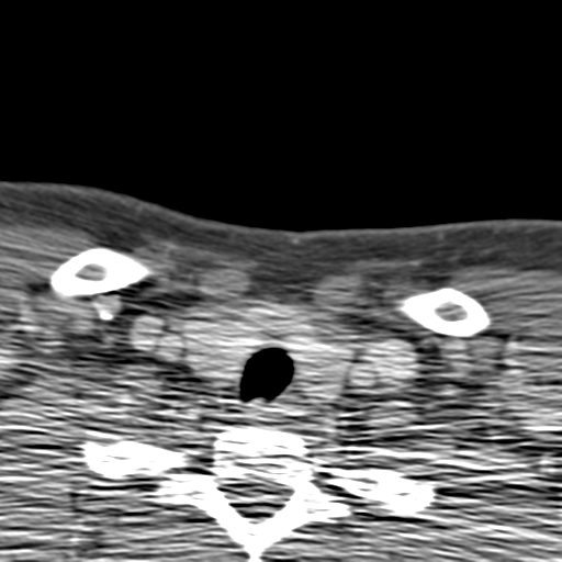File:Anterior cerebral artery territory infarct (Radiopaedia 39327-41581 B 96).png