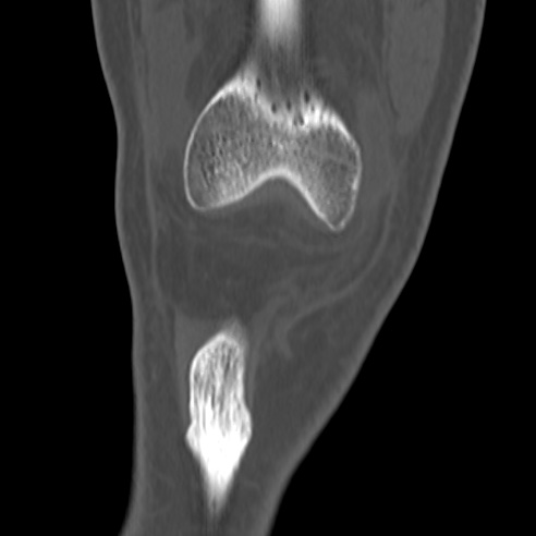 File:Anterior cruciate ligament avulsion fracture (Radiopaedia 58939-66194 Coronal bone window 2).jpg