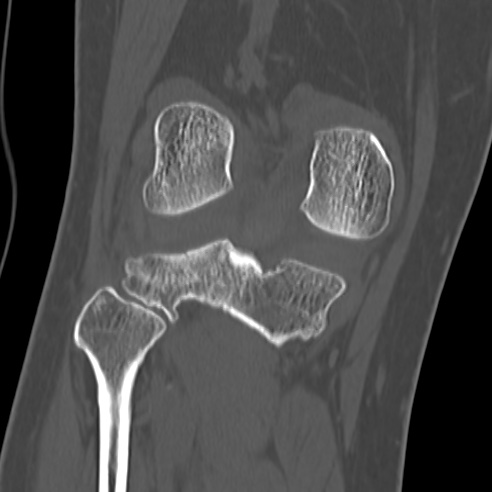 File:Anterior cruciate ligament avulsion fracture (Radiopaedia 58939-66194 Coronal bone window 24).jpg