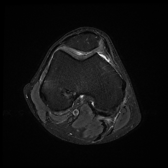 File:Anterior cruciate ligament graft tear and bucket-handle tear of medial meniscus (Radiopaedia 75867-87254 Axial PD fat sat 17).jpg