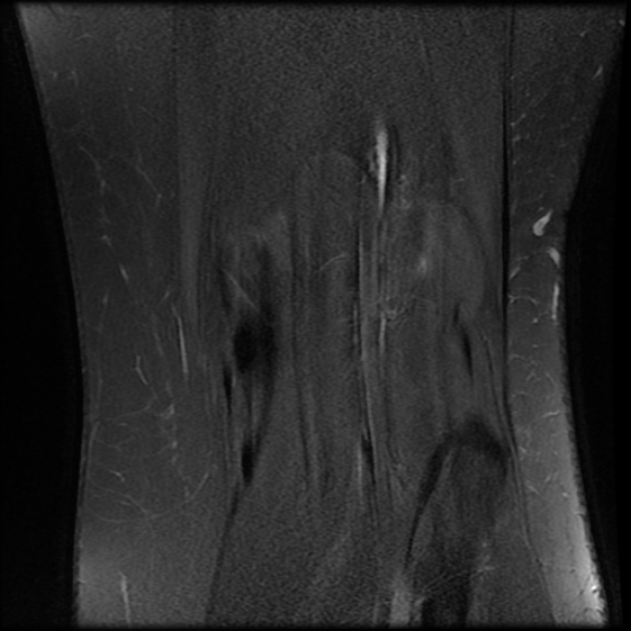 File:Anterior cruciate ligament tear, Wrisberg rip and bucket-handle tear of medial meniscus (Radiopaedia 75872-87266 Coronal PD fat sat 23).jpg
