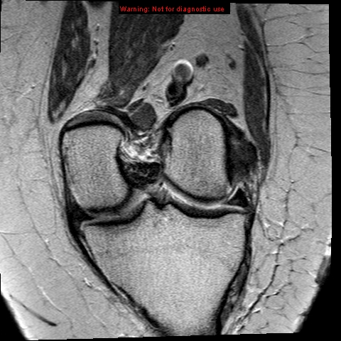 File:Anterior cruciate ligament tear - complete (Radiopaedia 12175-12514 Coronal PD 9).jpg