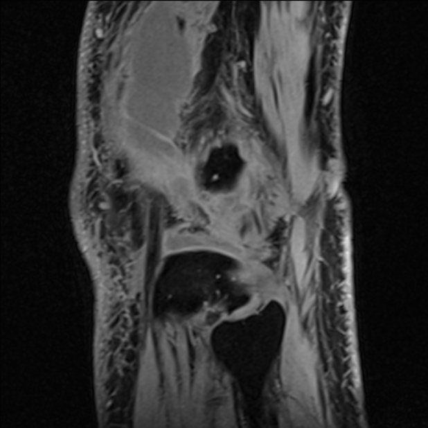 Anterior cruciate ligament tear - ramp lesion (Radiopaedia 71883-82322 Sagittal T1 vibe 22).jpg