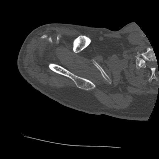 Anterior glenohumeral dislocation with Hill-Sachs lesion (Radiopaedia 62877-71249 Axial bone window 17).jpg