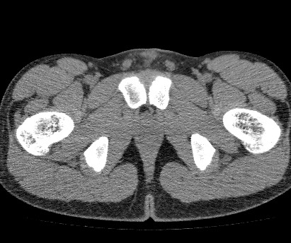 Anterior inferior iliac spine avulsion fracture (Radiopaedia 81312-94999 Axial non-contrast 65).jpg