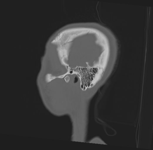 Anterior nasal spine fracture (Radiopaedia 46138-50494 Sagittal bone window 49).png
