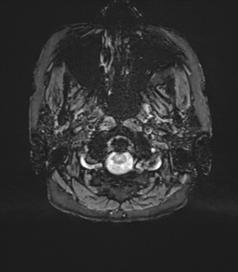 Anterior temporal pole cysts (Radiopaedia 46629-51102 Axial SWI 3).png