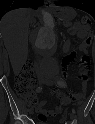 Anterior vertebral scalloping (abdominal aortic aneurysm) (Radiopaedia 66744-76067 Coronal bone window 17).jpg