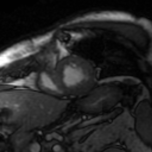 File:Anteroseptal hypokinesia after myocardial infarction (Radiopaedia 15978-15633 Short axis SSFE 14).jpg