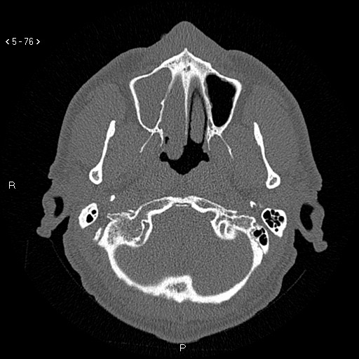 Antrochoanal Polyp (Radiopaedia 70510-80631 Axial bone window 24).jpg
